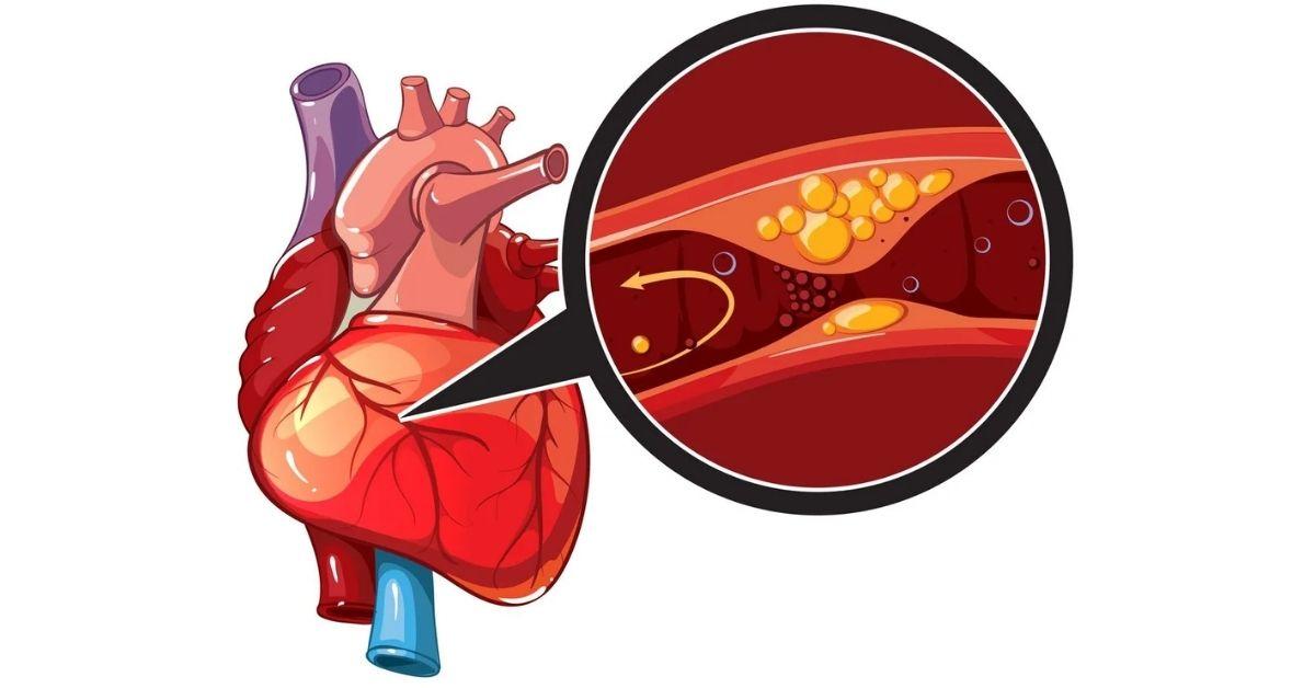 10 soruda koroner kalp hastalığı