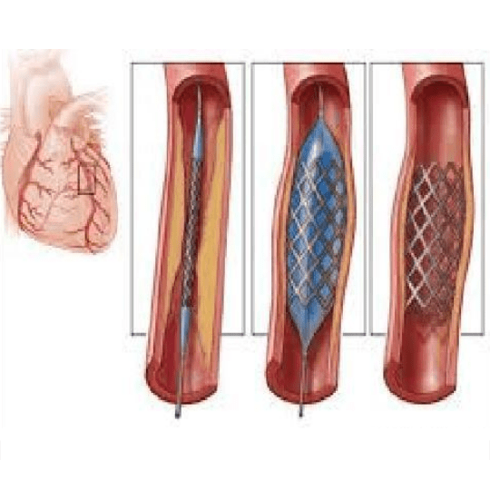 Koroner kalp hastalığı tedavisinde stent