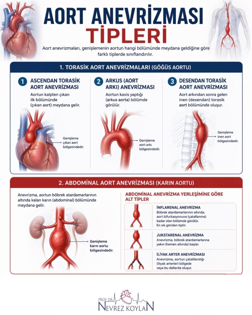 “Aort anevrizmaları tipleri” başlıklı 4:5 oranlı infografik: üst bölümde torasik aort anevrizmaları üç başlık altında gösteriliyor (çıkan aort, aort arkı ve inen torasik aort) ve her biri anatomik çizimler üzerinde etiketlenmiş. Alt bölümde abdominal aort anevrizması karın bölgesinde genişleme ile gösterilmiş; yanında yerleşime göre alt tipler (infrarenal, jukstarenal ve iliak arter anevrizmaları) küçük şemalarla açıklanmış. Görselde ayrıca kısa açıklamalar, bölgesel işaretlemeler ve temiz tıbbi ikonlar bulunuyor; genel tasarım kırmızı ve mavi tonlarında, sade ve eğitici bir infografik düzenine sahip.