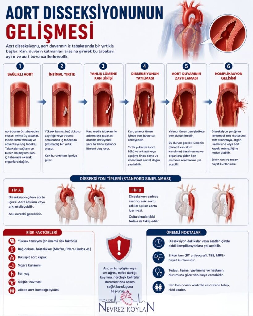 “Aort disseksiyonunun gelişmesi” başlıklı 4:5 oranlı infografik: üstte başlık ve kısa açıklama, sağda kalp ve aort üzerinde disseksiyonun yakınlaştırılmış kesit görüntüsü yer alıyor. Orta bölümde süreç adım adım görselleştirilmiş: sağlıklı aort → intimal yırtık → yalancı lümene kan girişi → disseksiyonun yayılması → aort duvarının zayıflaması → komplikasyon gelişimi. Alt bölümde Stanford sınıflamasına göre Tip A ve Tip B disseksiyon şemaları, risk faktörleri (hipertansiyon, genetik hastalıklar, sigara, ileri yaş vb.) ve önemli klinik noktalar ikonlarla sunuluyor; genel tasarım kırmızı ve mavi tonlarında, tıbbi ve eğitici bir anlatıma sahip.
