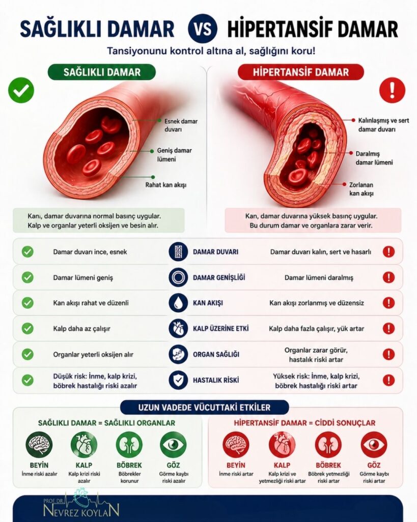 “Sağlıklı damar vs hipertansif damar” başlıklı görselde; geniş ve esnek yapıya sahip sağlıklı damar ile daralmış, duvarı kalınlaşmış hipertansif damar yan yana karşılaştırmalı olarak gösteriliyor, kan akışı farkı oklar ve şemalarla vurgulanıyor.