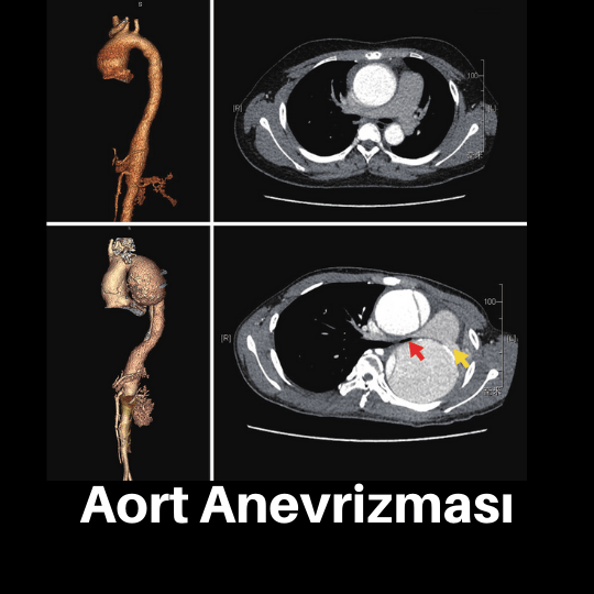 Aort anevrizması