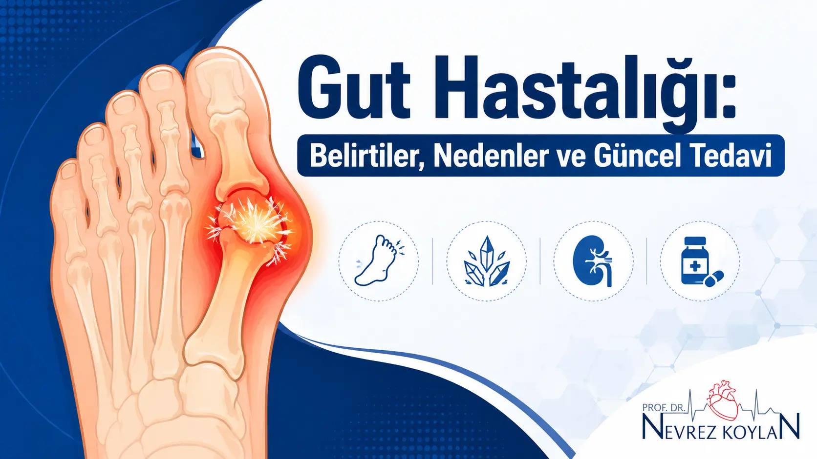 Gut hastalığında başparmak eklemi iltihabı ve ürik asit kristalleri