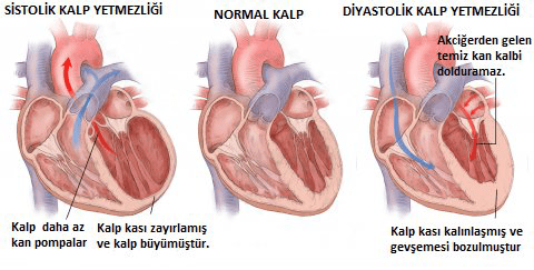 Sistolik ve diyastolik kalp yetersizliği bedir?