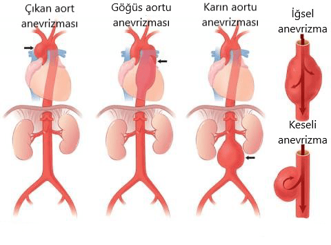 Aort anevrizmalası sınıflandırılması