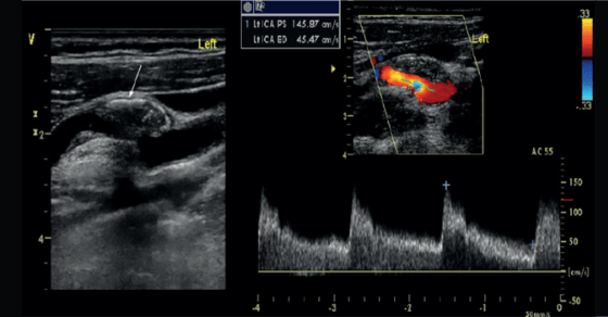 Boyun damarlarında Doppler ultrasonografi