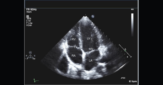 Transtorasik ekokardiyografi görüntüsünde kalp boşlukları
