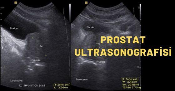 Prostat ultrasonografisi