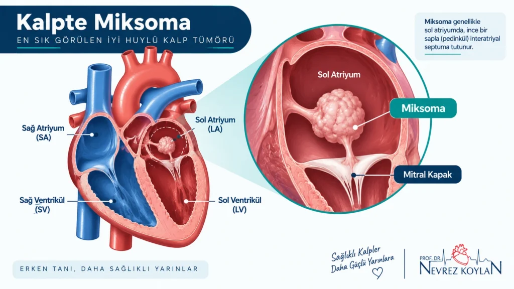 Sol atriyumda yerleşmiş kalp miksomasını gösteren anatomik diyagram