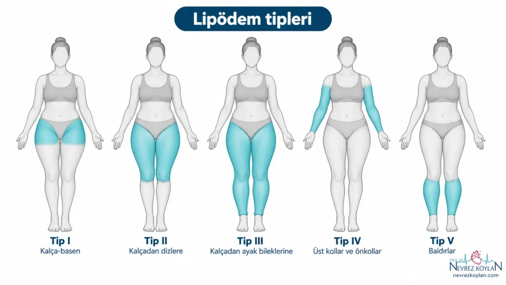 Lipödem tipleri: kalça, kalçadan dizlere, kalçadan ayak bileğine, kollar ve baldırlardaki yağ birikimini gösteren beş vücut silueti