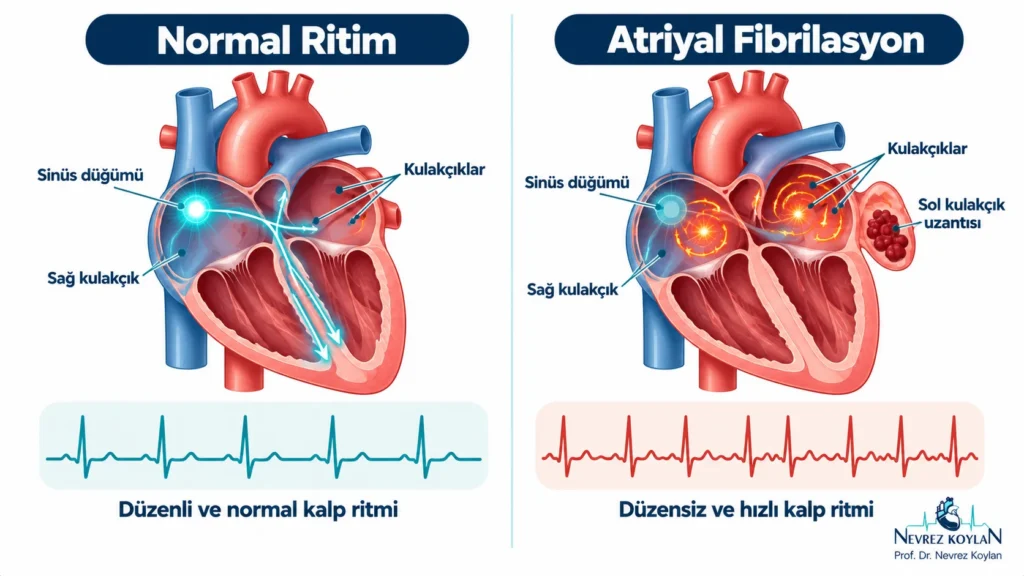 Atriyal fibrilasyon ile normal kalp ritminin karşılaştırması: düzenli sinüs ritmi ve kulakçıklarda kaotik elektrik dalgaları ile düzensiz EKG gösteren infografik