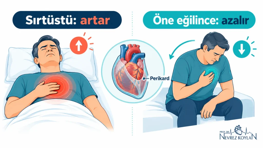 Perikardit ağrısı: sırtüstü yatınca artan, öne eğilip oturunca hafifleyen göğüs ağrısını gösteren iki aşamalı illüstrasyon