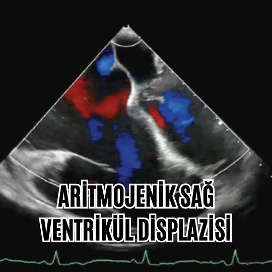 Aritmojenik sağ ventrikül displazisi