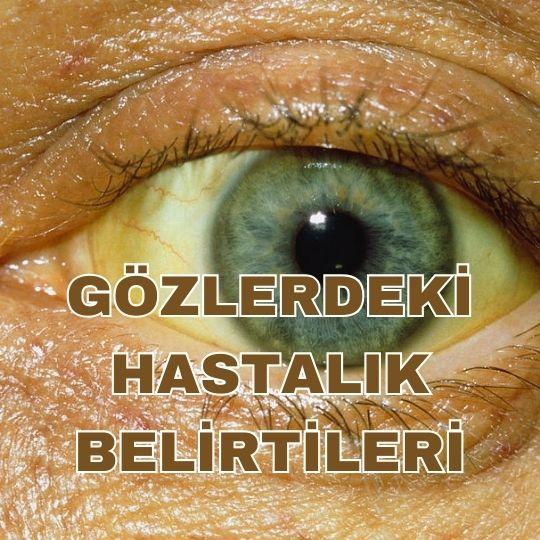 Gözlerdeki hastalık belirtileri