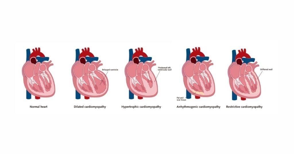 Kardiyomiyopati türleri