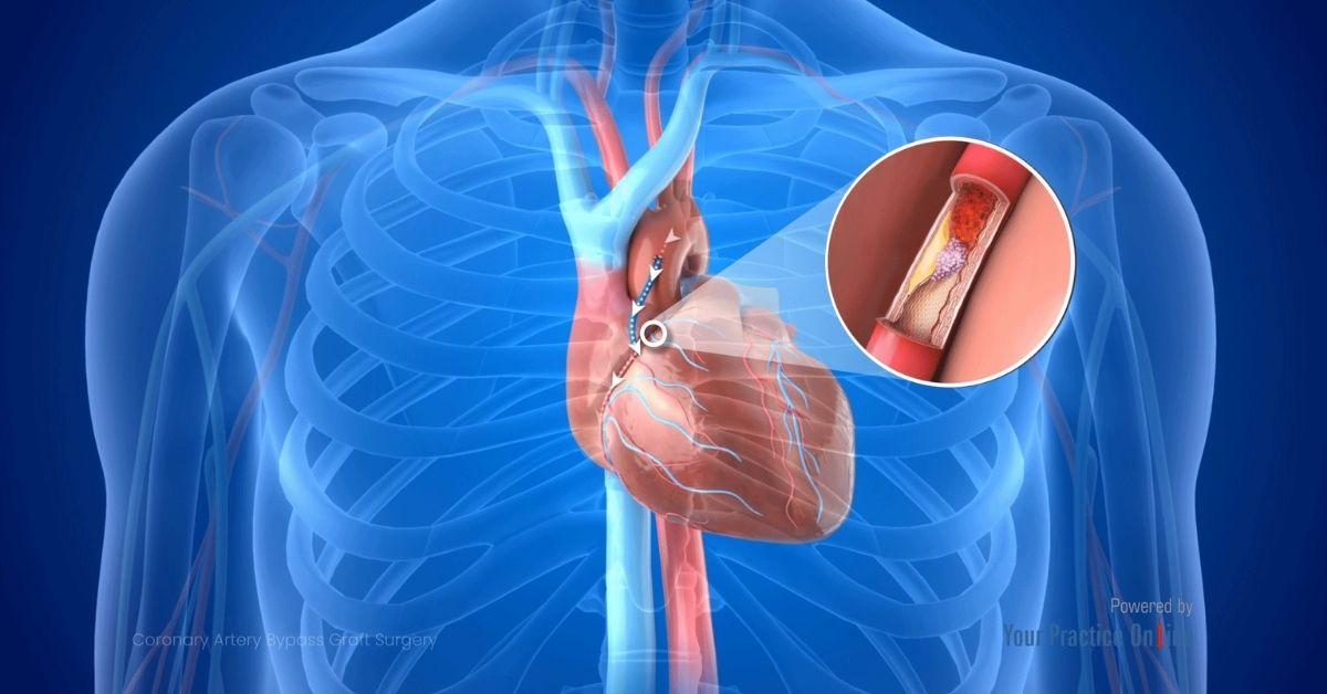 Bypass veya Stent Sonrası Neler Yapılmalı?