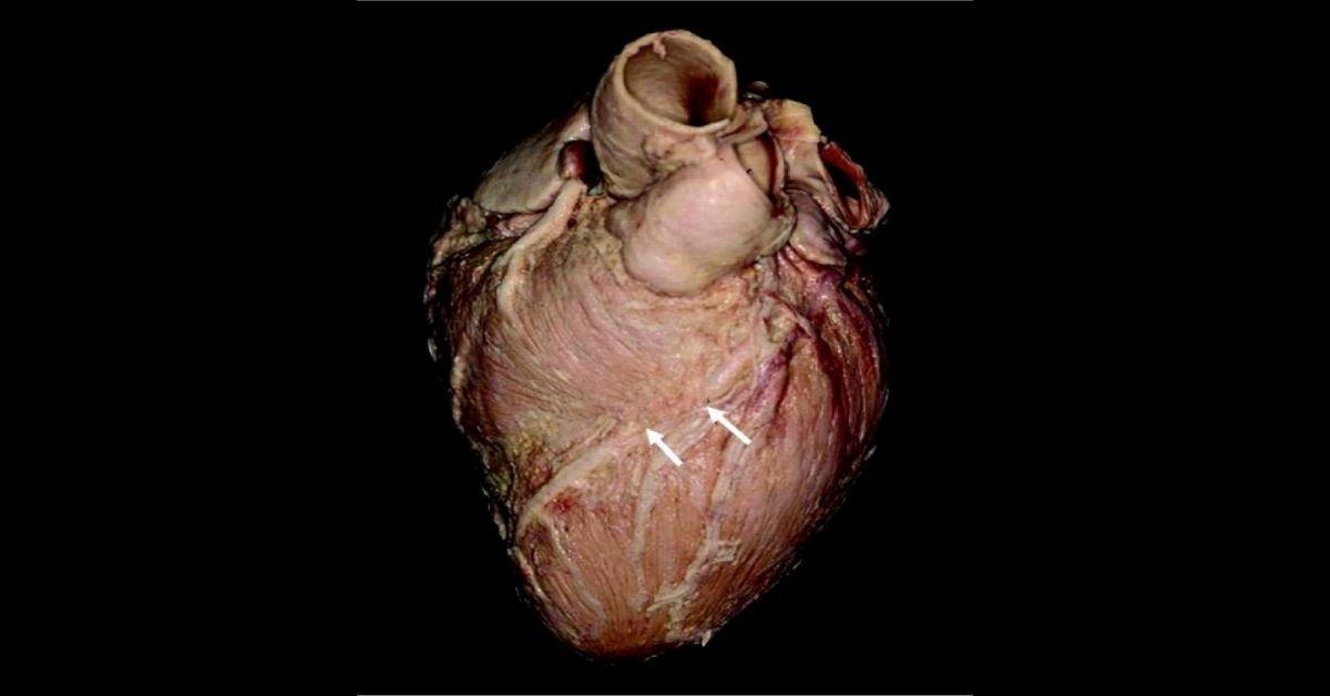 Myokardiyal Köprü (Myocardial Bridge) Nedir?