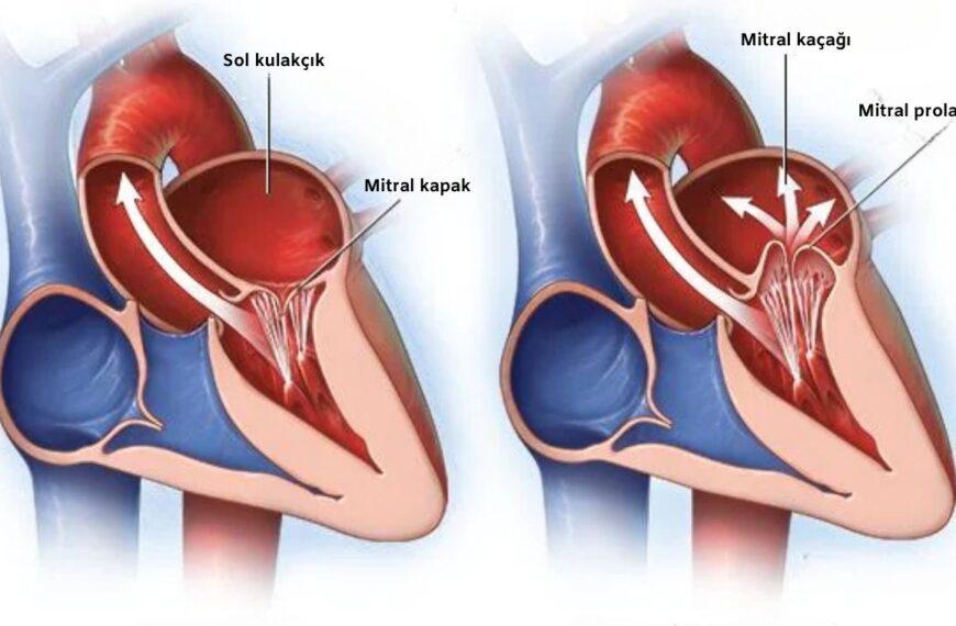 Mitral prolapsusu