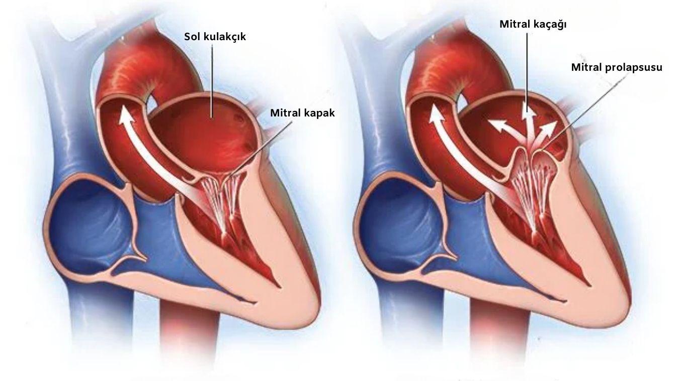 Mitral Prolapsusu Nedir? Belirtileri, Nedenleri ve Tedavisi