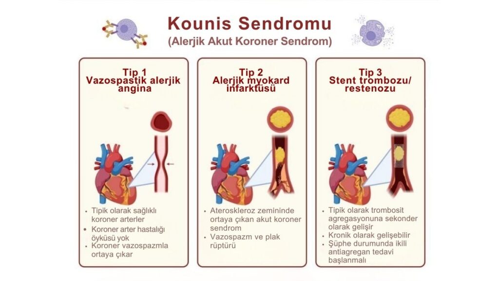 Kounis sendromu tipleri