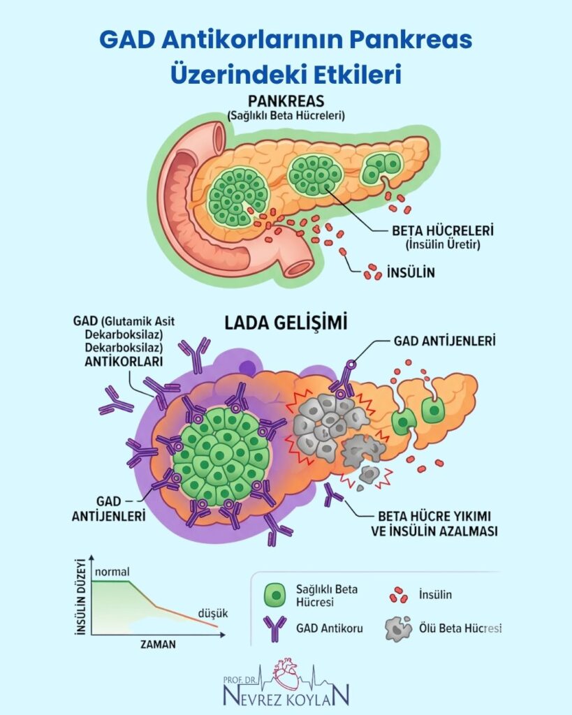 GAD antikorlarının pankreas üzerindeki etkileri