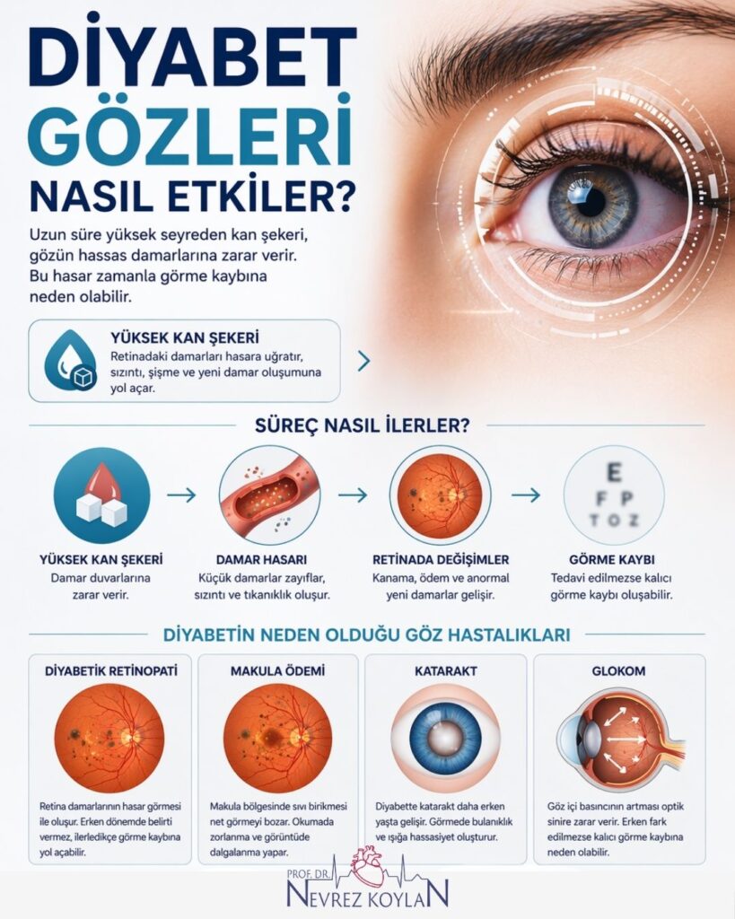 “Diyabet gözleri nasıl etkiler?” başlıklı infografikte, yüksek kan şekerinin retina damarlarına zarar vererek damar hasarı, retina değişiklikleri ve görme kaybına yol açabileceği adım adım gösteriliyor; ayrıca diyabetik retinopati, makula ödemi, katarakt ve glokom gibi göz hastalıkları görsellerle açıklanıyor ve kan şekeri kontrolü, düzenli göz muayenesi, sağlıklı yaşam ve sigarayı bırakma gibi korunma önerileri sunuluyor.