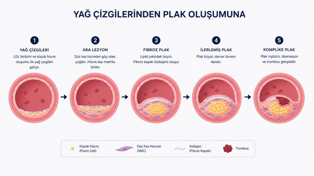 Yağ çizgisinden fibröz plağa ve damar daralmasına kadar ilerleyen ateroskleroz gelişim sürecini gösteren şematik görsel