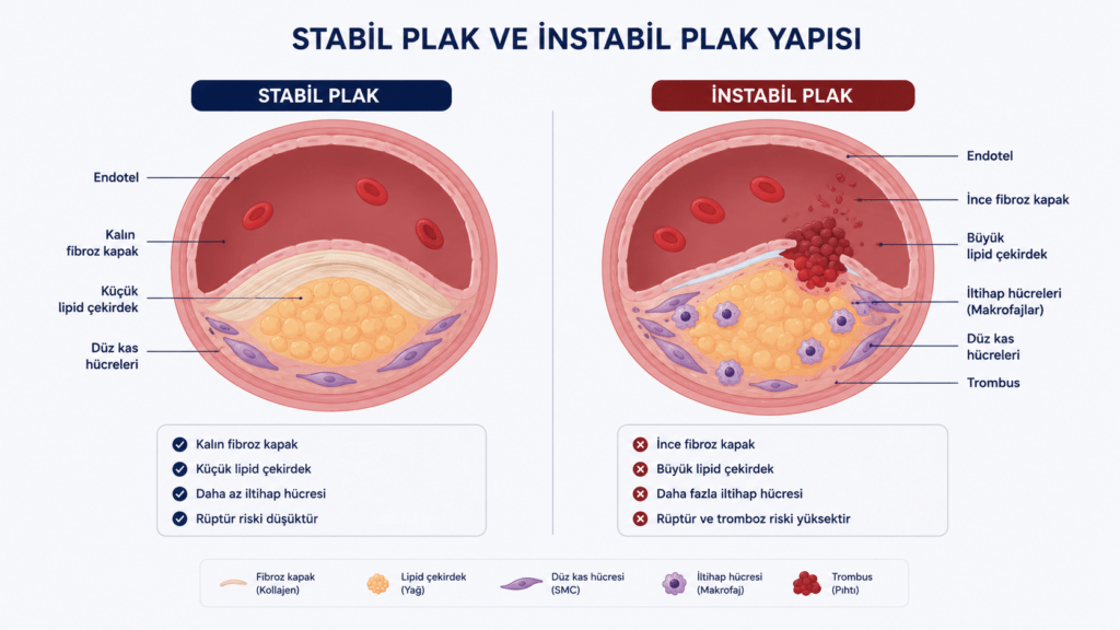 Stabil ve instabil aterosklerotik plakların yapısal özelliklerini, inflamasyonu ve tromboz riskini karşılaştıran damar kesiti görseli
