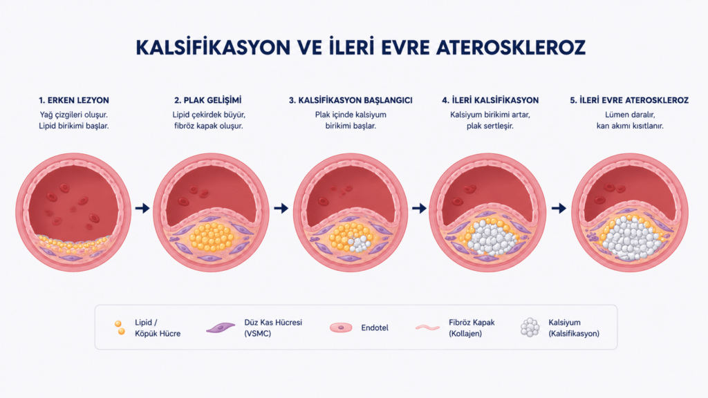 Plak içinde kalsifikasyon gelişimi, damar sertleşmesi ve ileri evre ateroskleroz oluşumunu gösteren damar kesiti görseli