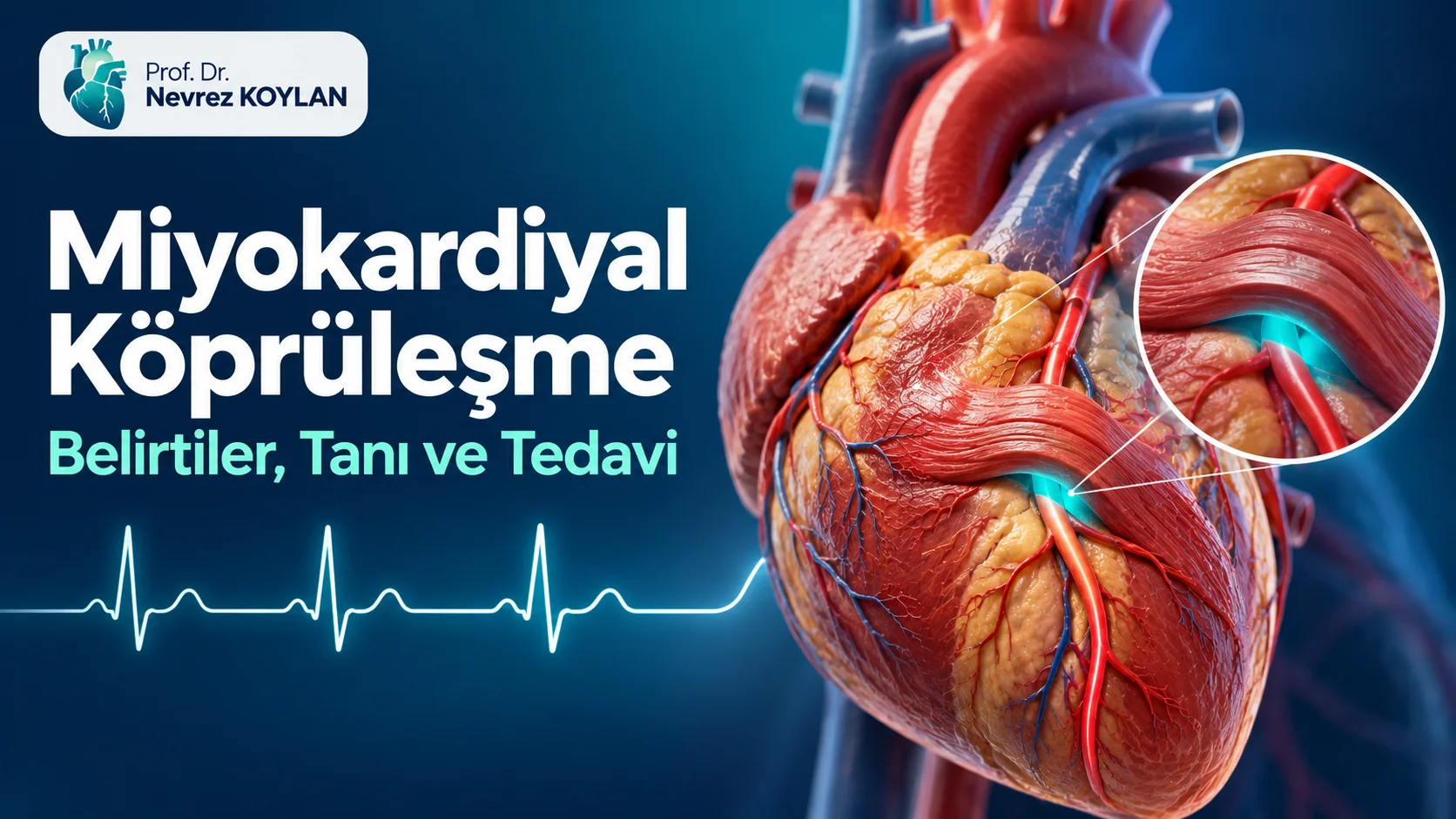 Miyokardiyal köprüleşme kapak görseli: kalp kası bandının altından geçen koroner damar illüstrasyonu ve Prof. Dr. Nevrez Koylan logosu